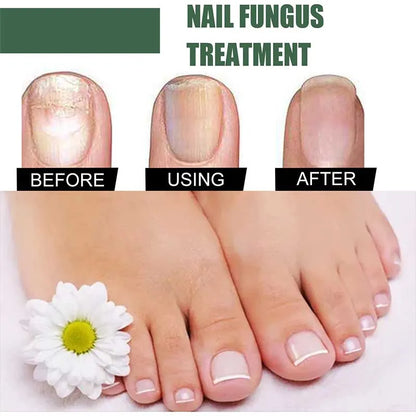 Anti-Funguses Nail Treatment
